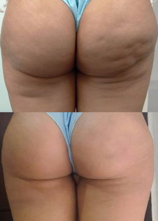 PROMO 🔥  ITZA FIT + FILM OSMÓTICO YODADO + CREMA GEL CRIOGÉNICA MIA + CREMA TERMO MIA