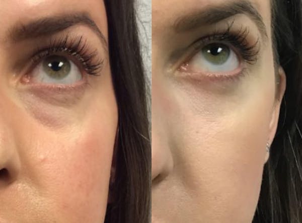 ISA ✨ VARITA MAGIC LED FACIAL